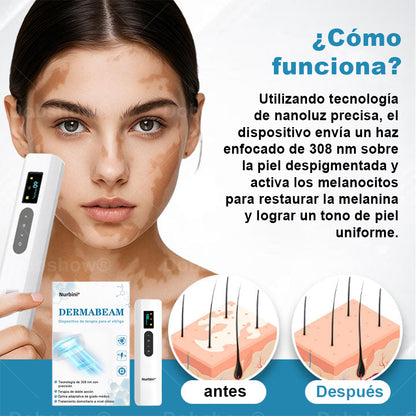 Nurbini® DermaBeam Instrumento para el tratamiento del vitíligo