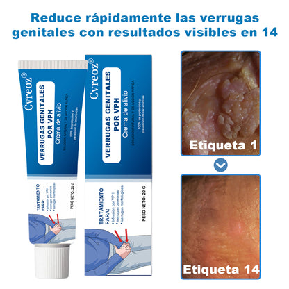 Cvreoz® Crema Alivio Verrugas Genitales VPH
