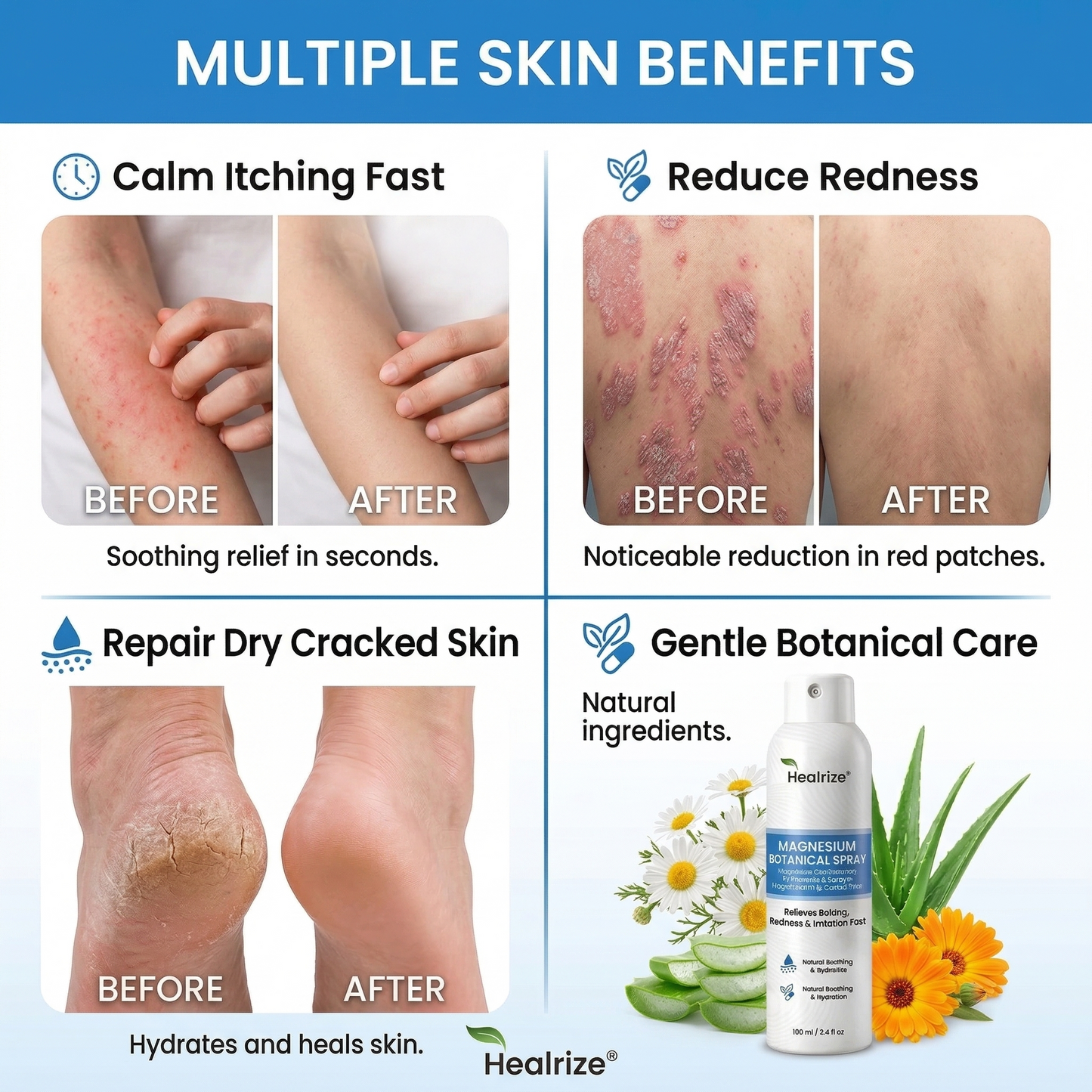 ✅ 𝙊𝙛𝙛𝙞𝙘𝙞𝙖𝙡 𝙎𝙩𝙤𝙧𝙚 | Healrize® Magnesium Botanical Spray – Advanced Skin Recovery for Psoriasis & Eczema | Rapid Soothing, Steroid-Free