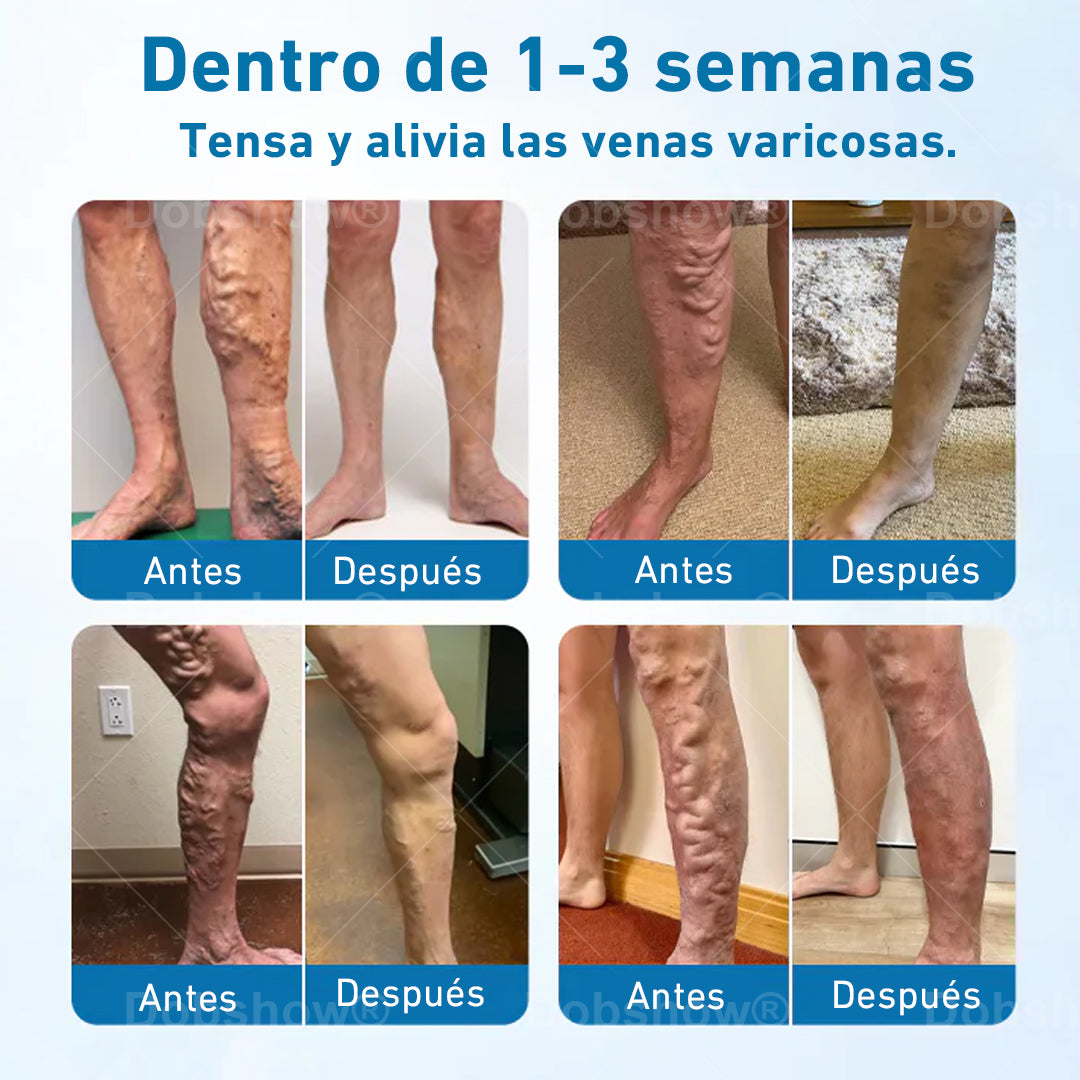Cvreoz® VeinGuard Spray a base de hierbas-✅ ¡Clínicamente probado para eliminar las venas varicosas en solo 7 días!