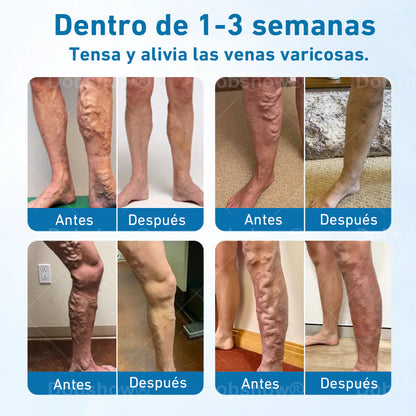 Cvreoz® VeinGuard Spray a base de hierbas-✅ ¡Clínicamente probado para eliminar las venas varicosas en solo 7 días!