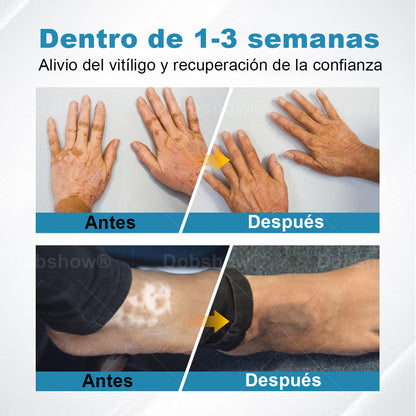 Nurbini® DermaBeam Instrumento para el tratamiento del vitíligo