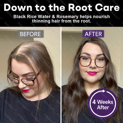 🔥Dobshow® Black Rice & Red Onion Hair Growth Spray