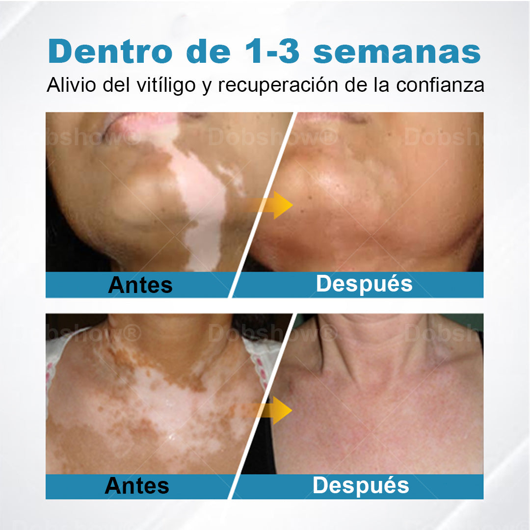 Nurbini® DermaBeam Instrumento para el tratamiento del vitíligo