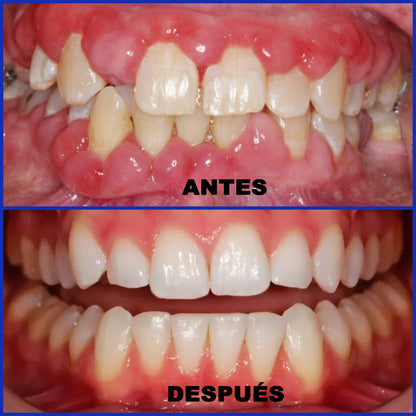 Dobshow® Microgránulos Dentales de Veneno de Abeja (🇲🇽 🦷 Aprobado)