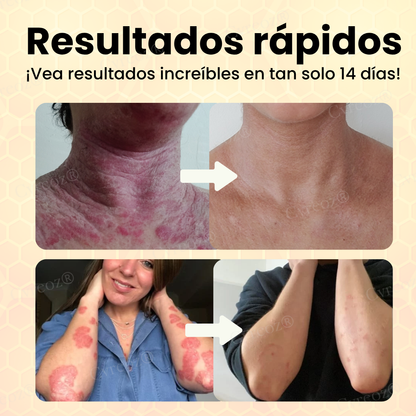 Cvreoz® Veneno de Abeja Psoriasis Crema de Cuidado