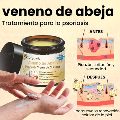 Cvreoz® Veneno de Abeja Psoriasis Crema de Cuidado